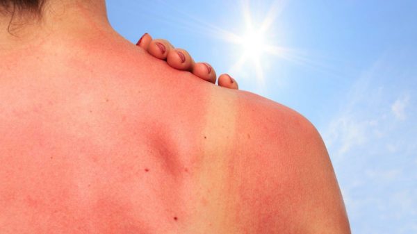 Lady with clear sunburn on her shoulders